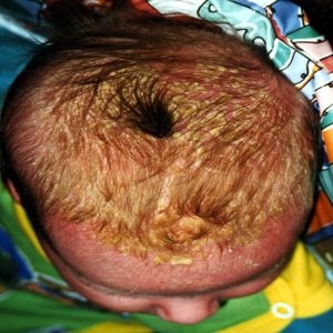 Does Cradle Cap Smell?